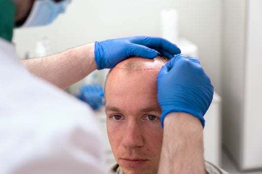The Ultimate Guide to Androgenetic Alopecia Treatments