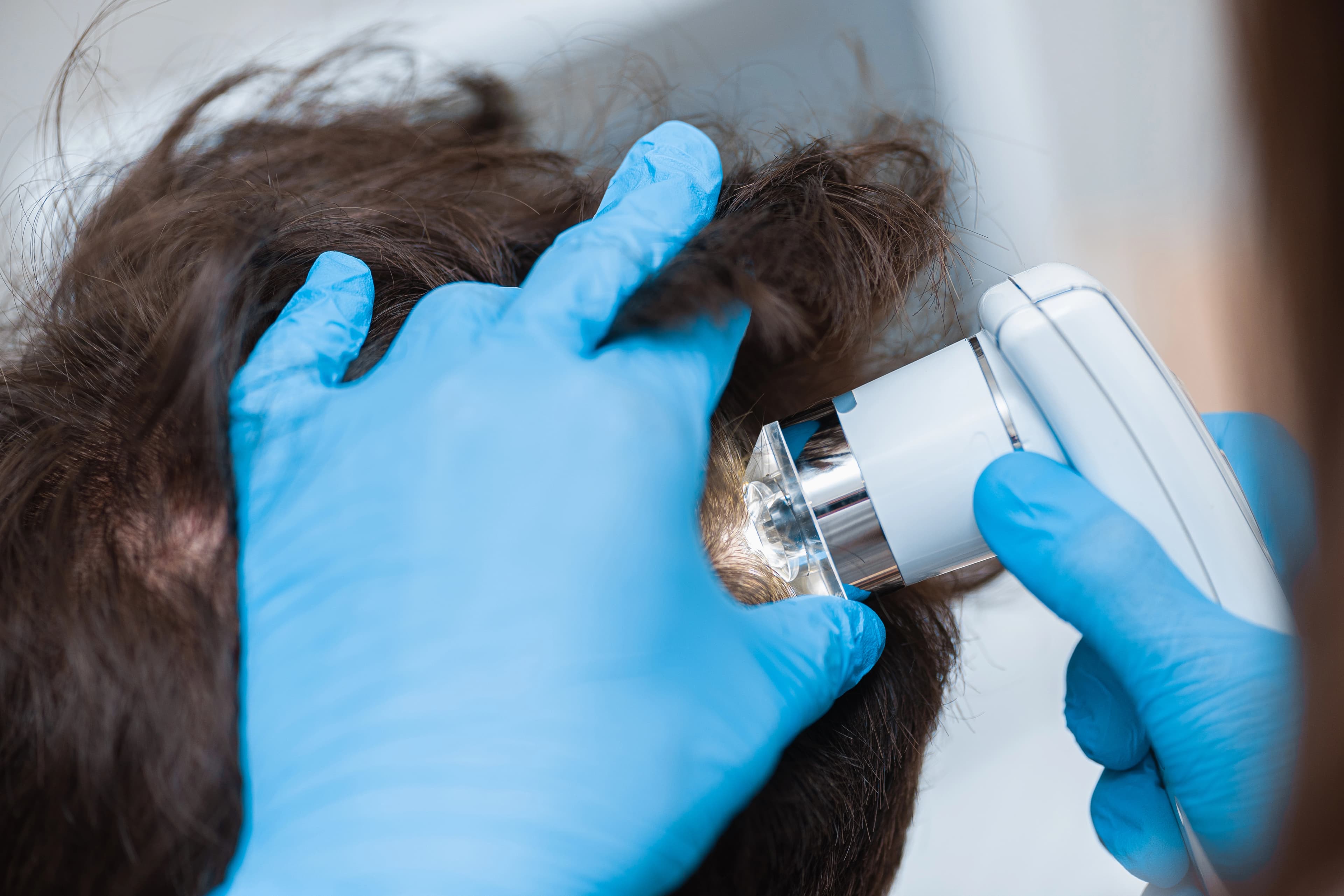 Autologous-Micro-Graft treatment