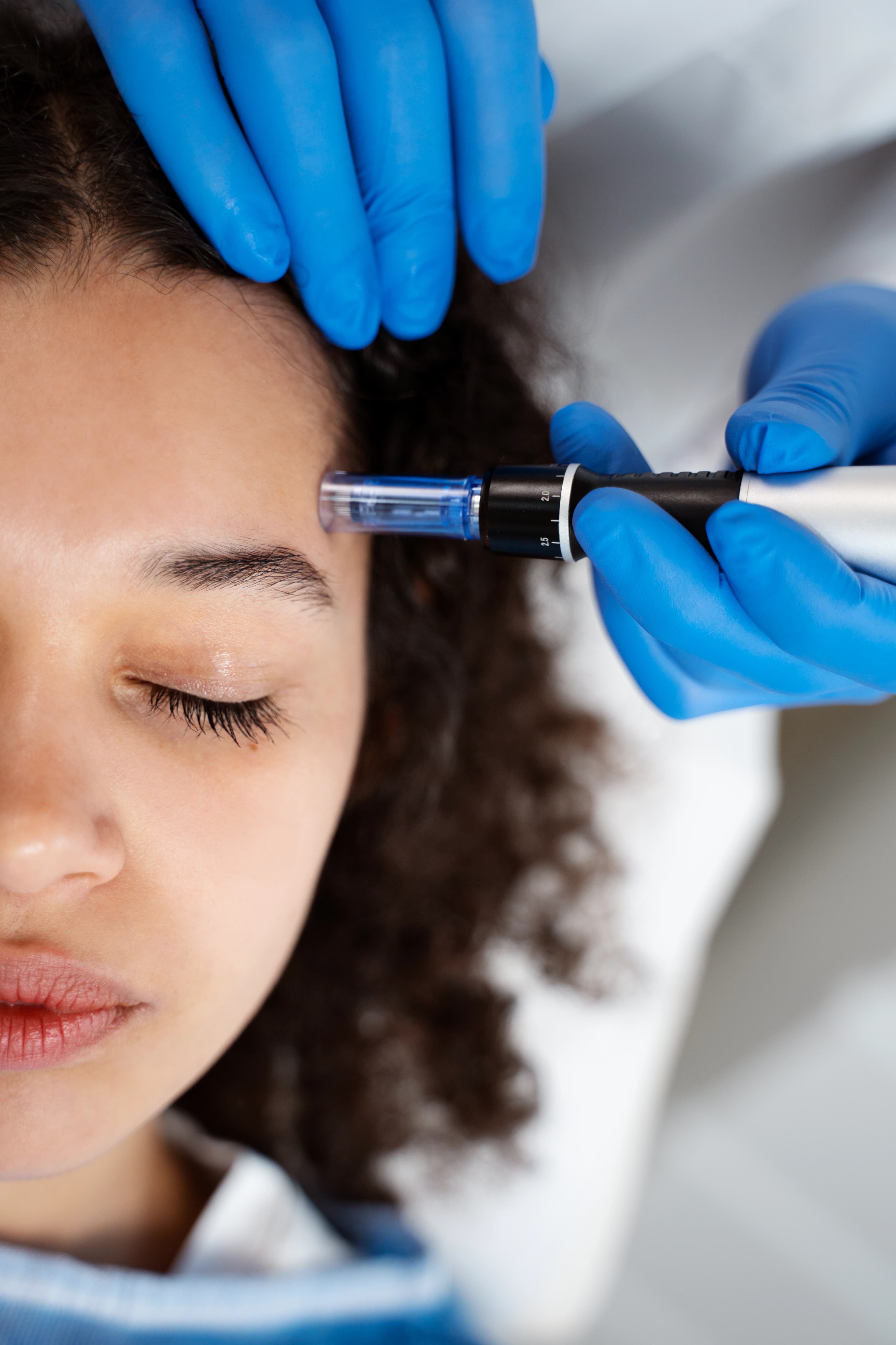 Autologous Micrograft Treatment