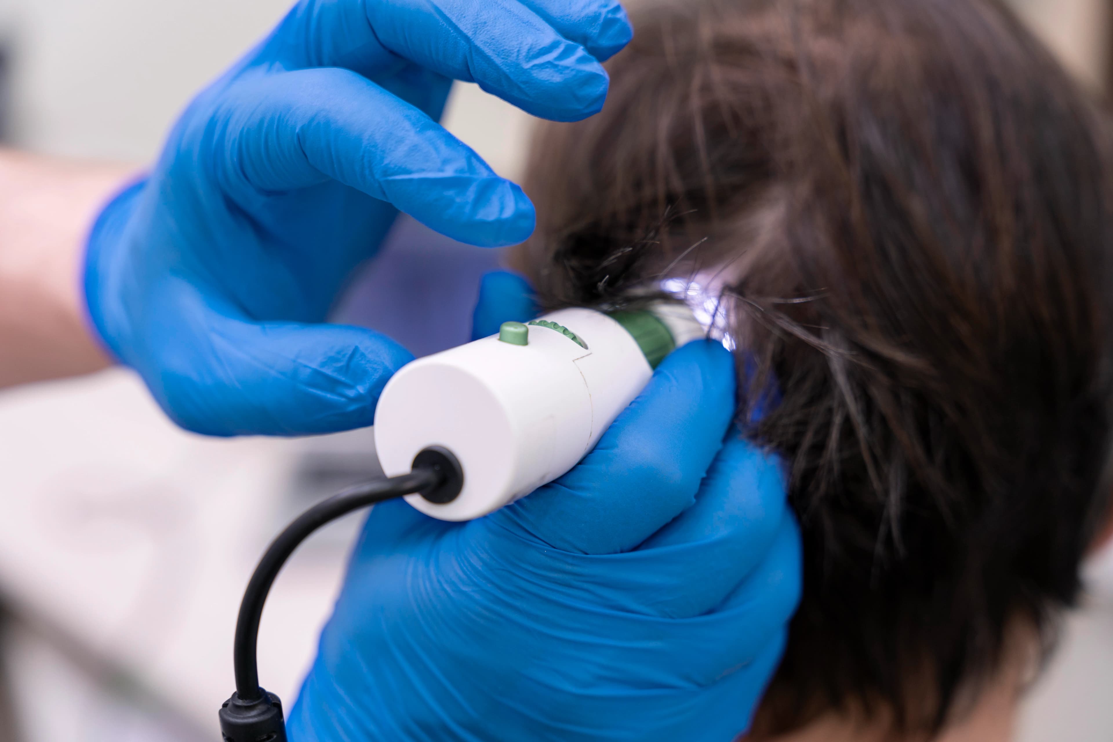 Microneedling for hair loss treatment