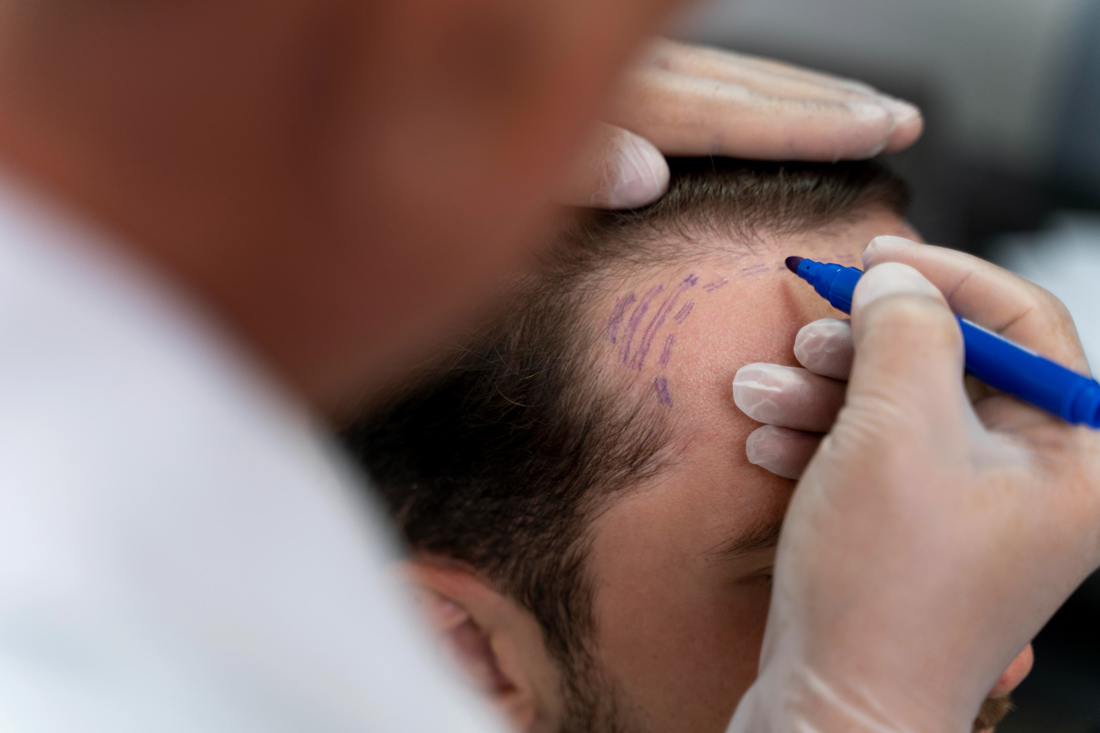 Hair Replacement treatment