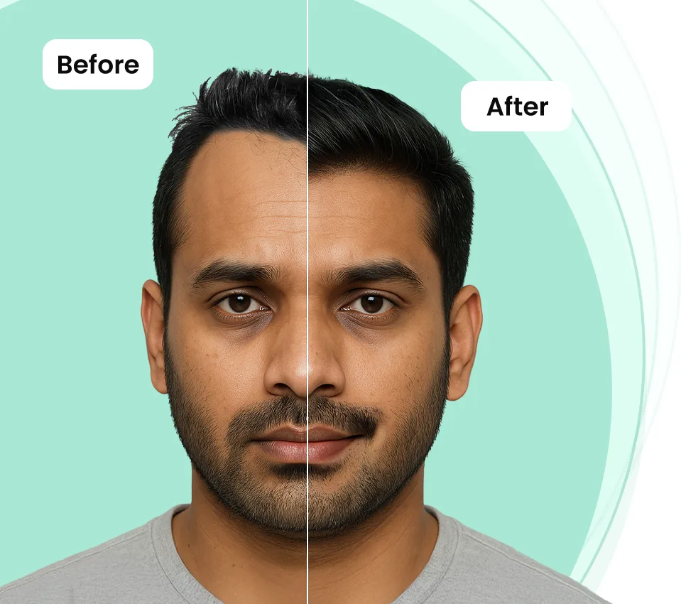 Split image of a man’s face labeled "Before" and "After," highlighting hair transplant results.