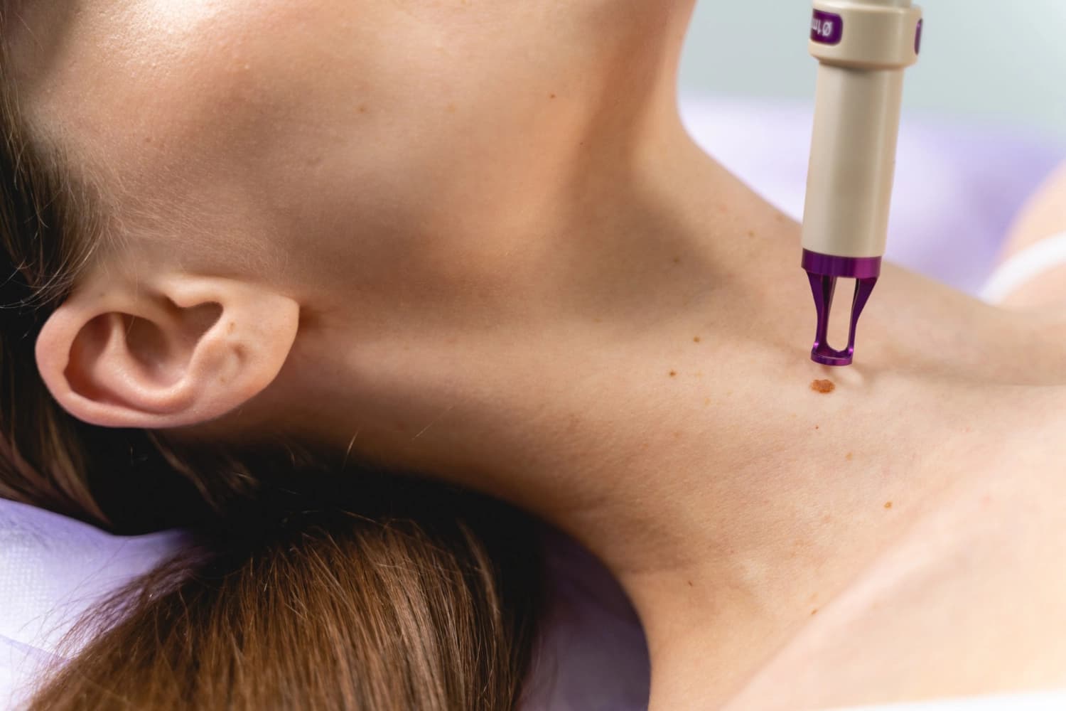 RF (Radiofrequency) Treatment