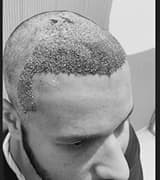 Hair Transplant