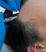 Hair Regrowth Treatments