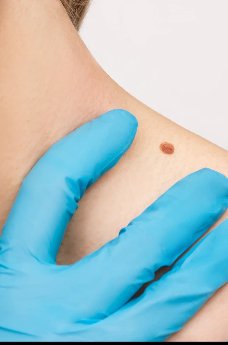 Mole Removal Treatment