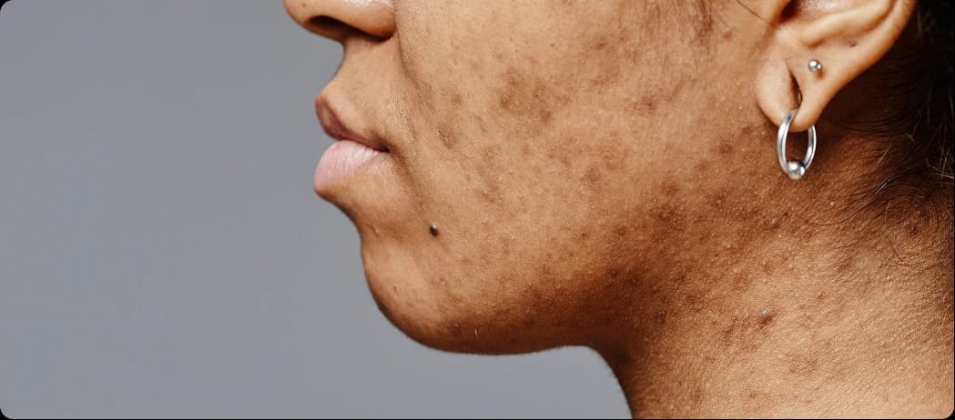 PIH (Post-Inflammatory Hyperpigmentation)
