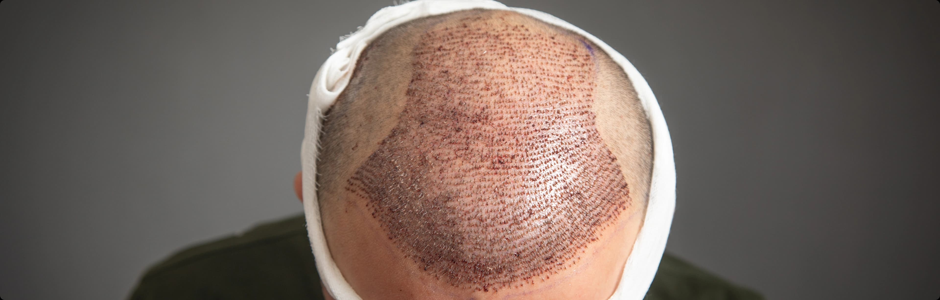 Hair Transplant Process