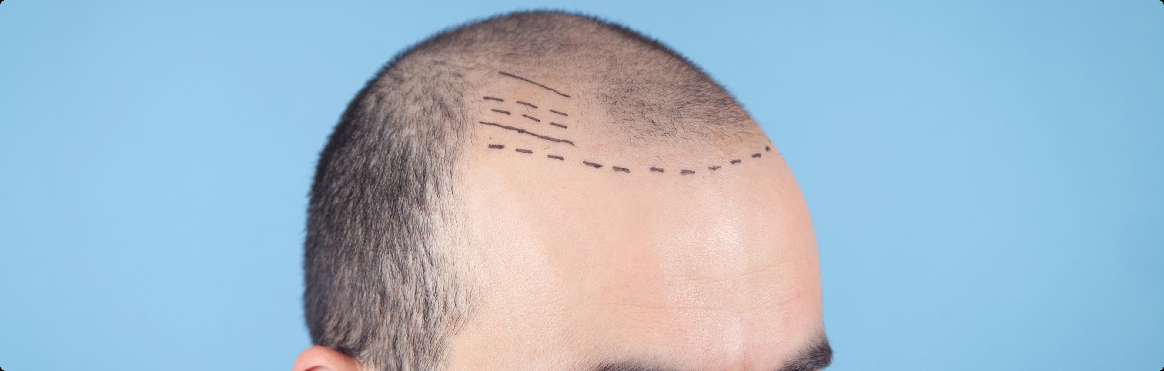 Hair Transplant Surgery
