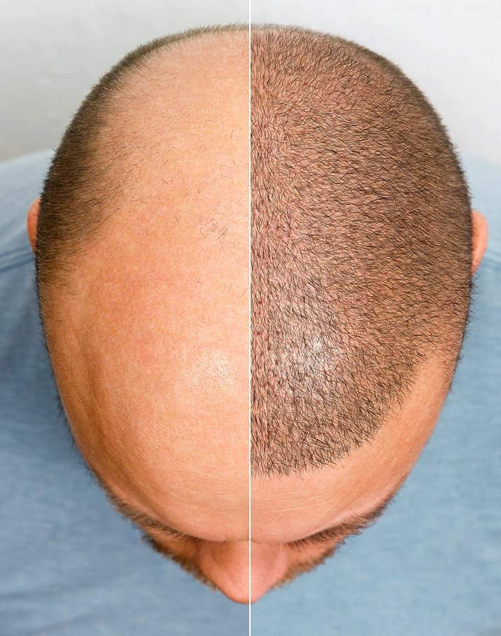 Custom Hairline Design