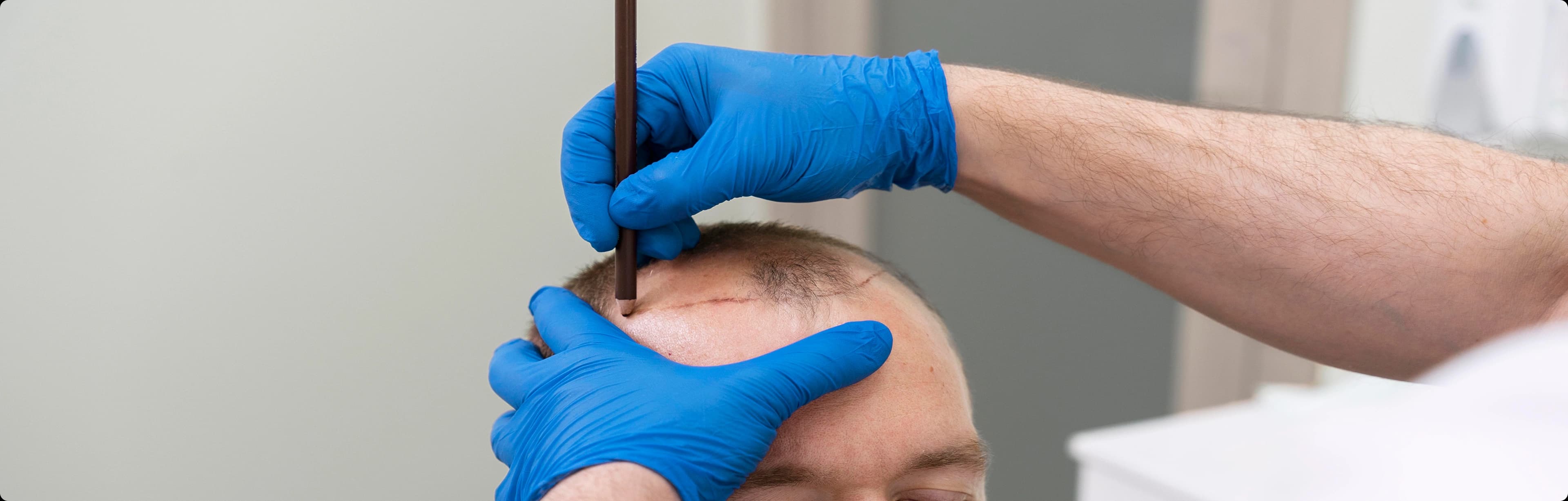 Hair Transplant Results