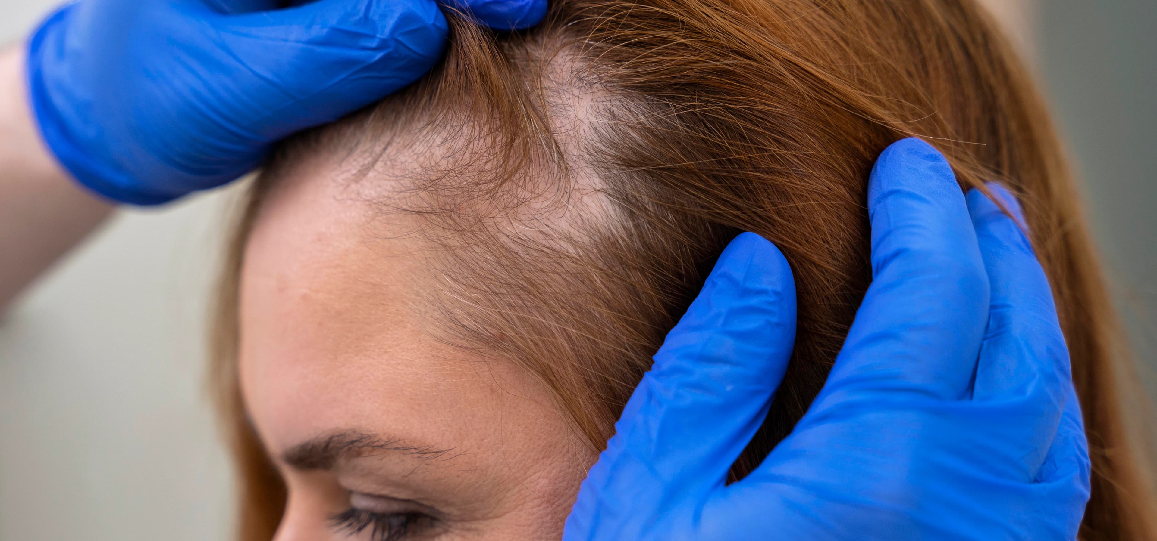 Female Hair Transplant Procedure