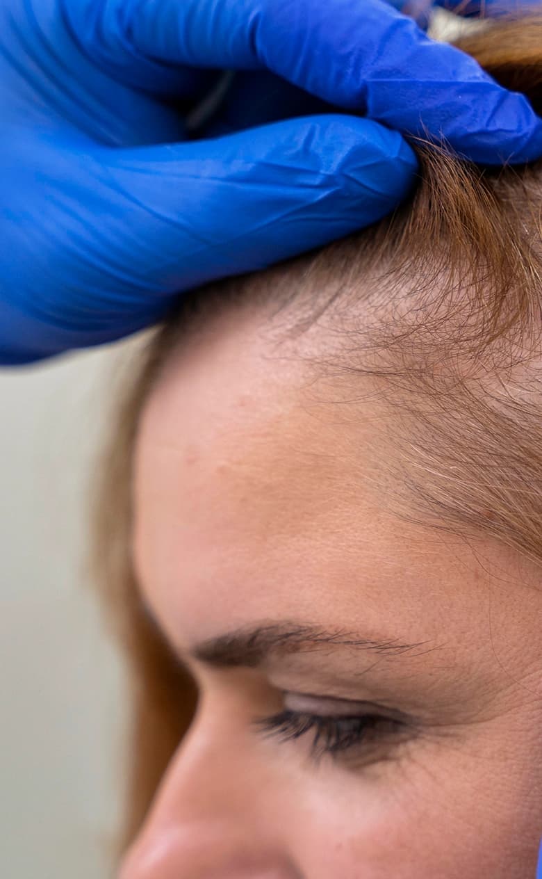 Female Hair Transplant Procedure
