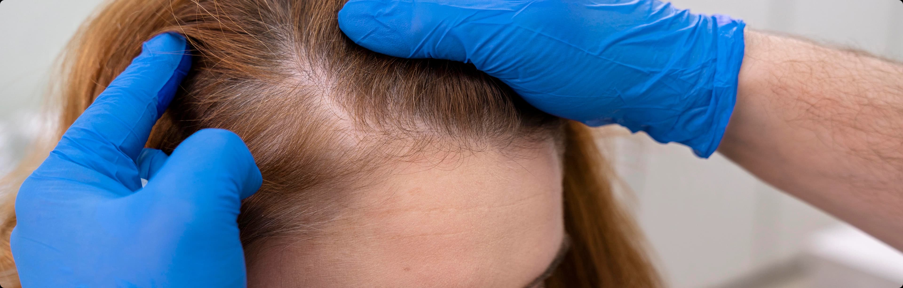Female Hair Transplant Results