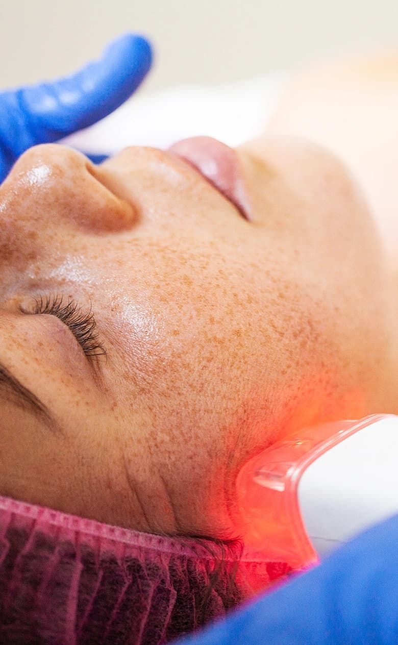 Low Level Laser Therapy for Hair Growth
