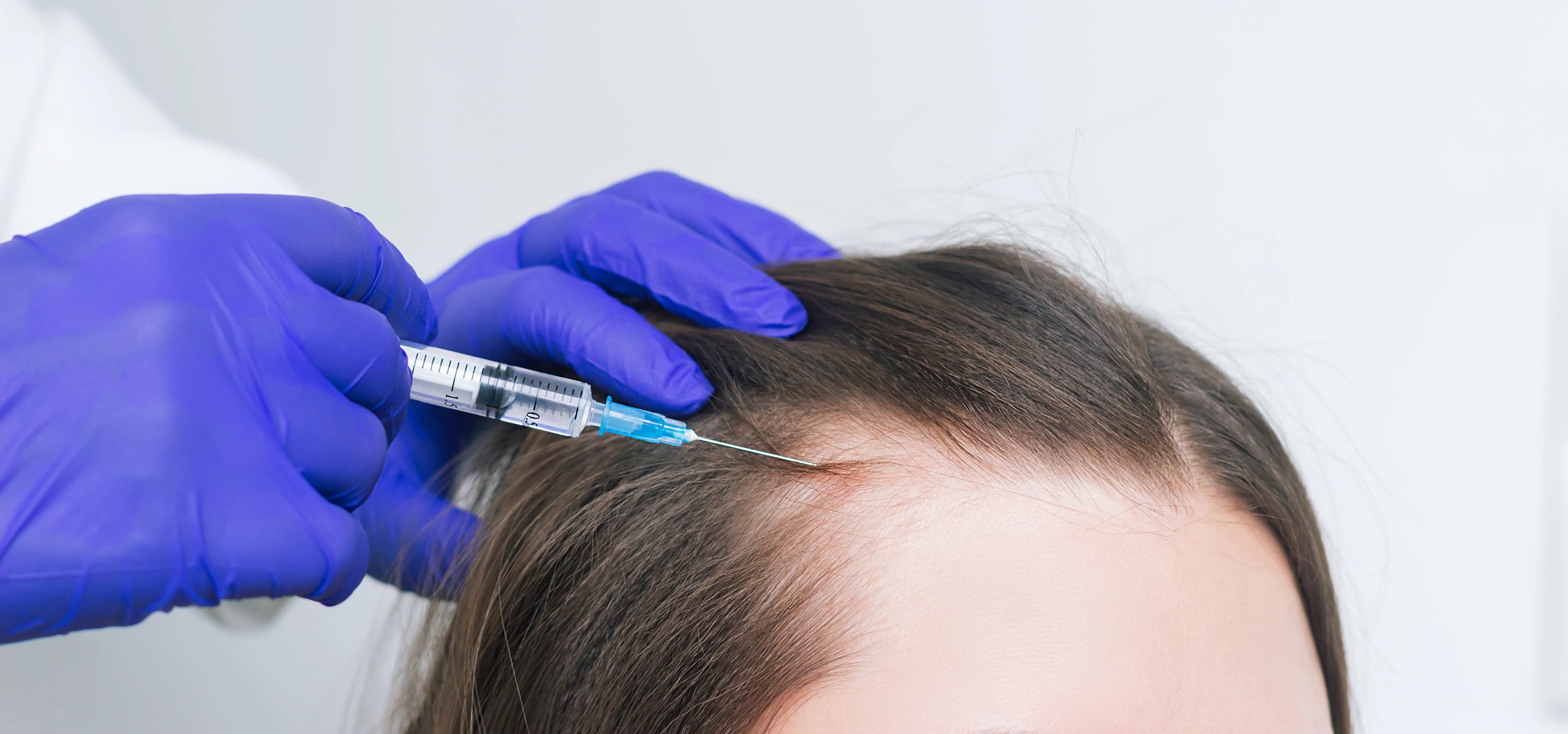 Microneedling for Hair Loss