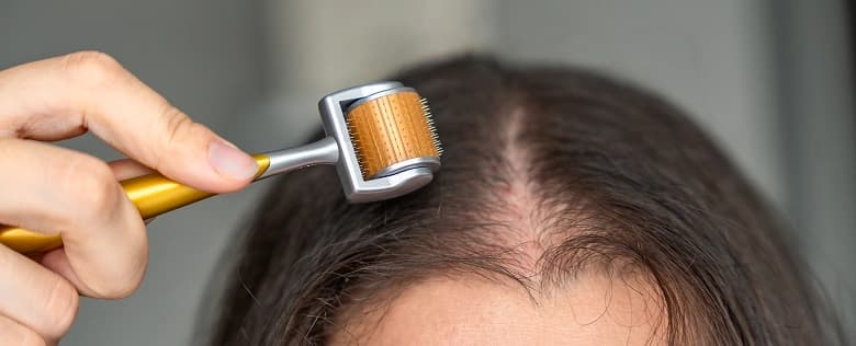Microneedling for Hair Loss