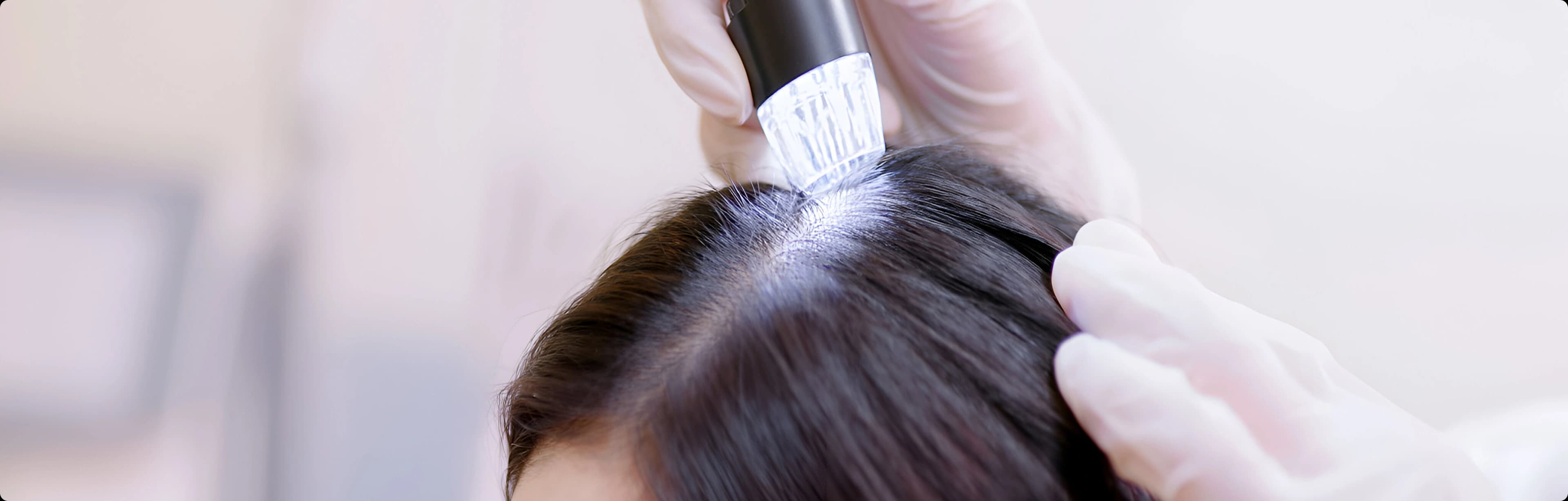 Microneedling procedure