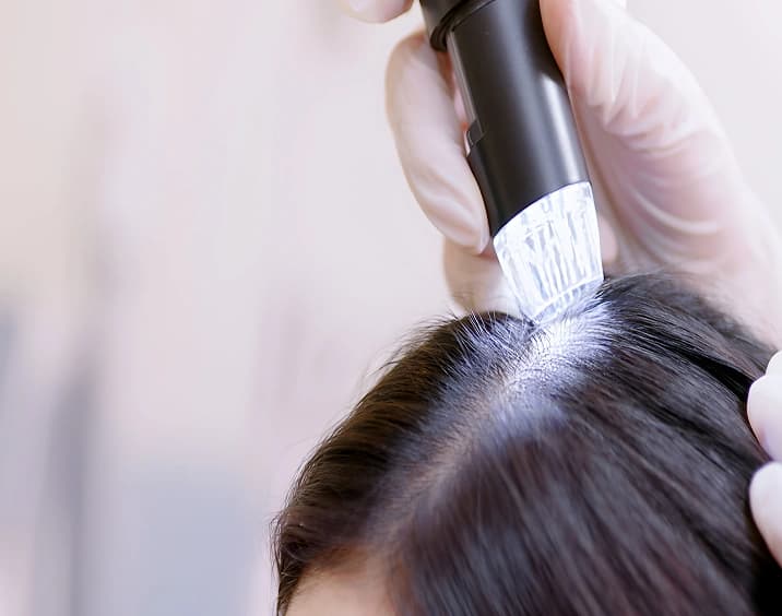 Microneedling procedure