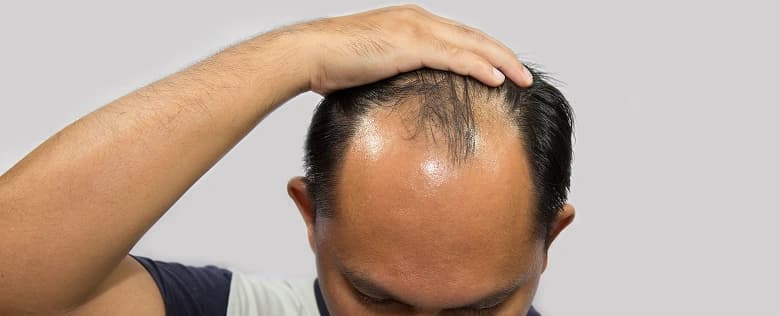 Custom Hair System Application