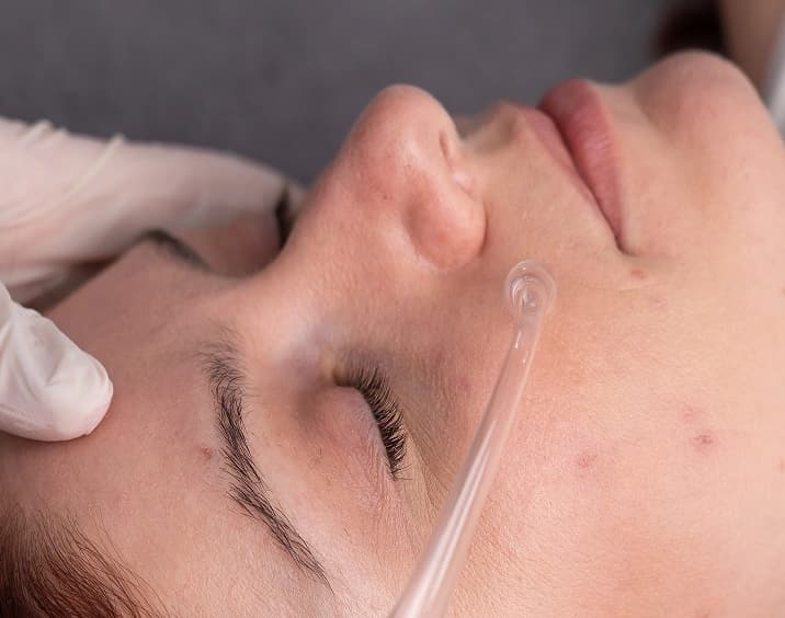 Chemical peel treatment