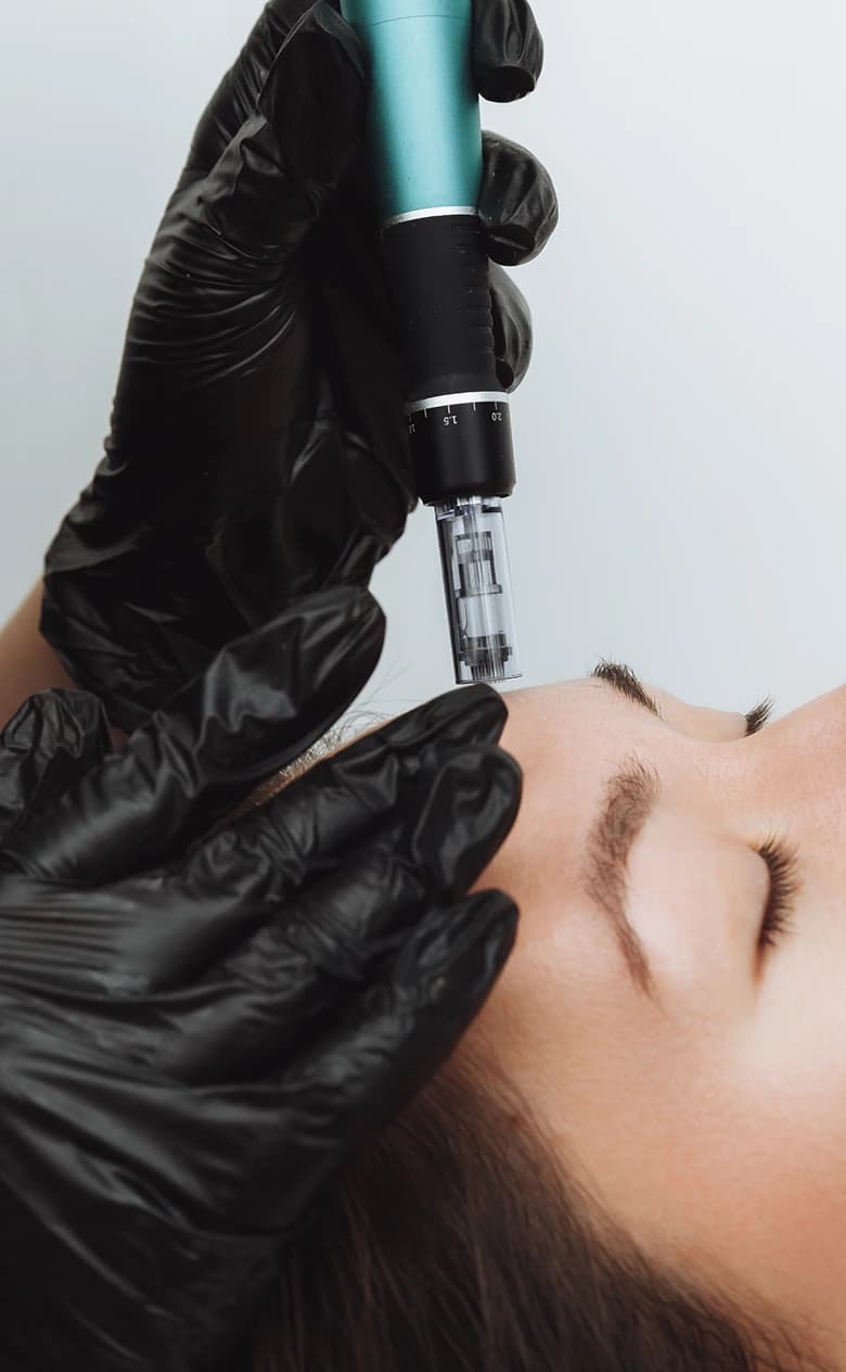 Mesotherapy Treatment