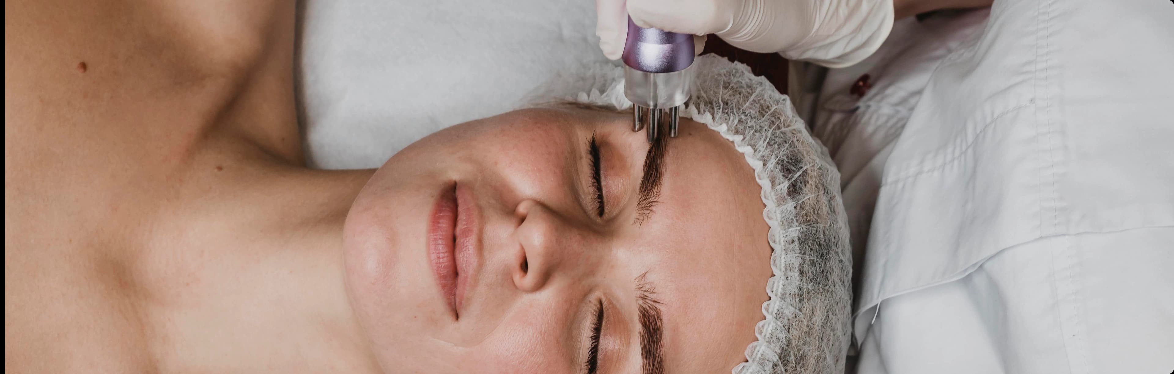 Microdermabrasion treatment benefits