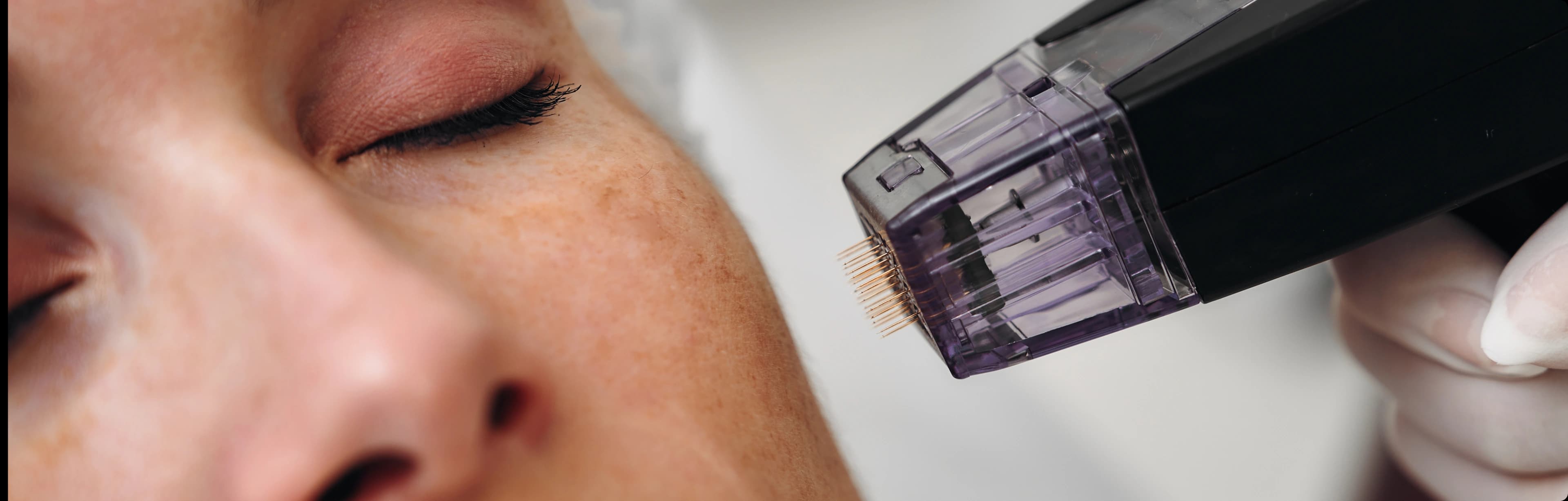 Microneedling Treatment