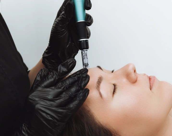 Microneedling treatment
