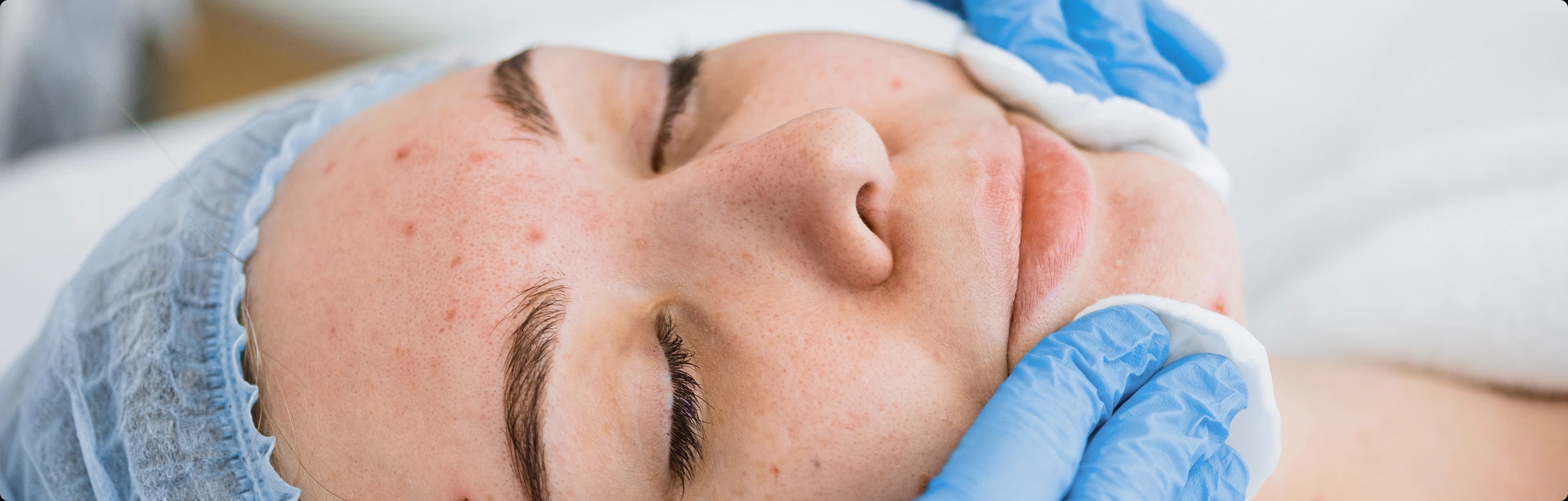 Scar treatment results