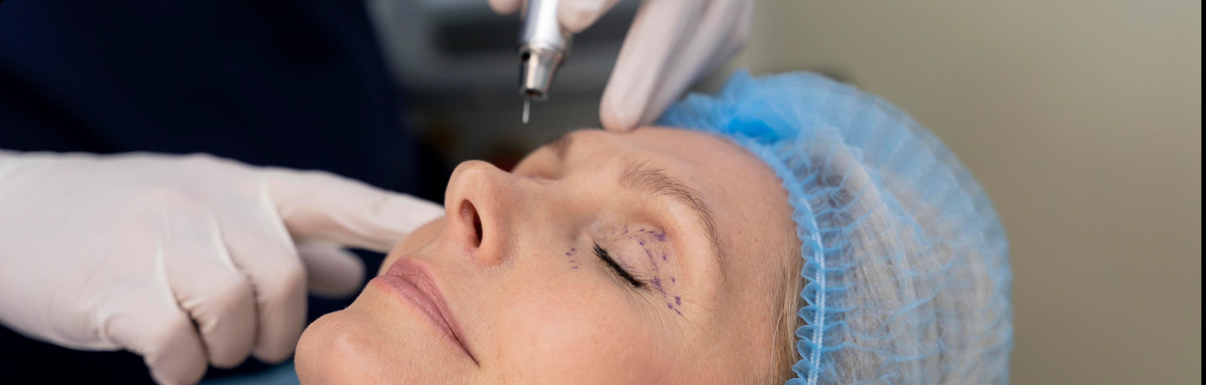 Subcision treatment benefits