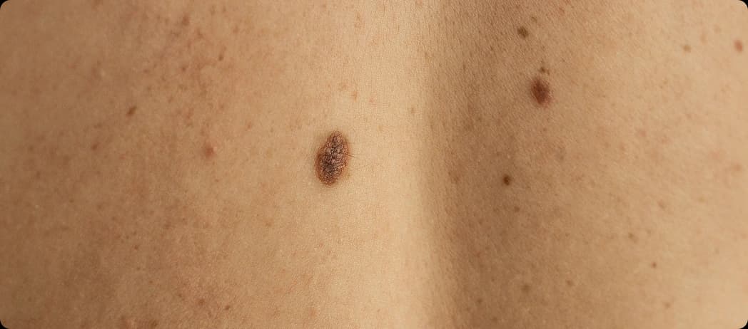 Flat Pigmented Moles