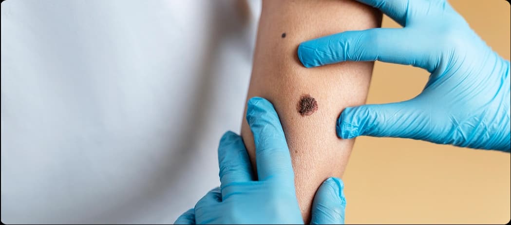 Atypical Moles or Nevus