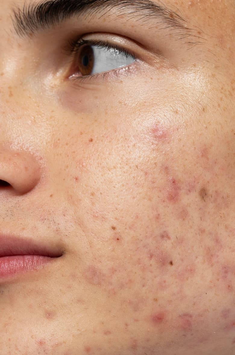Pigmentation Treatment