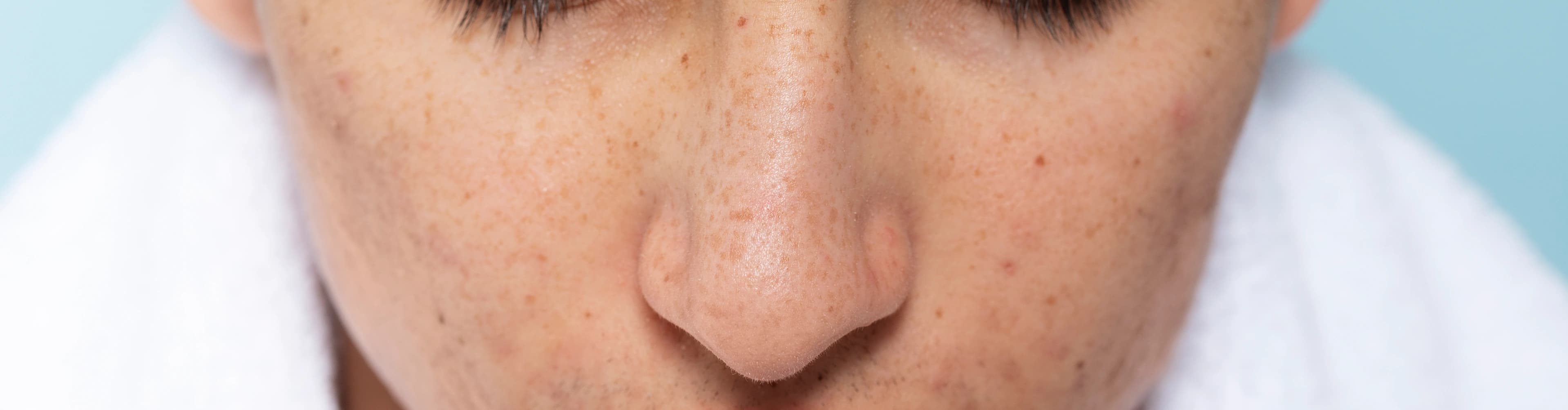 Types of Pigmentation