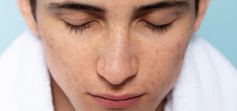 Types of Pigmentation