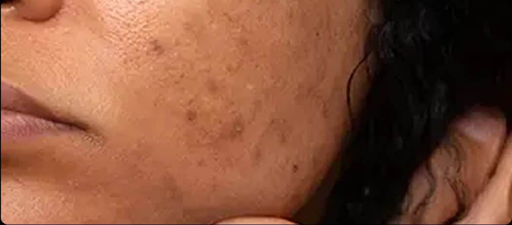 Freckles & Age Spots