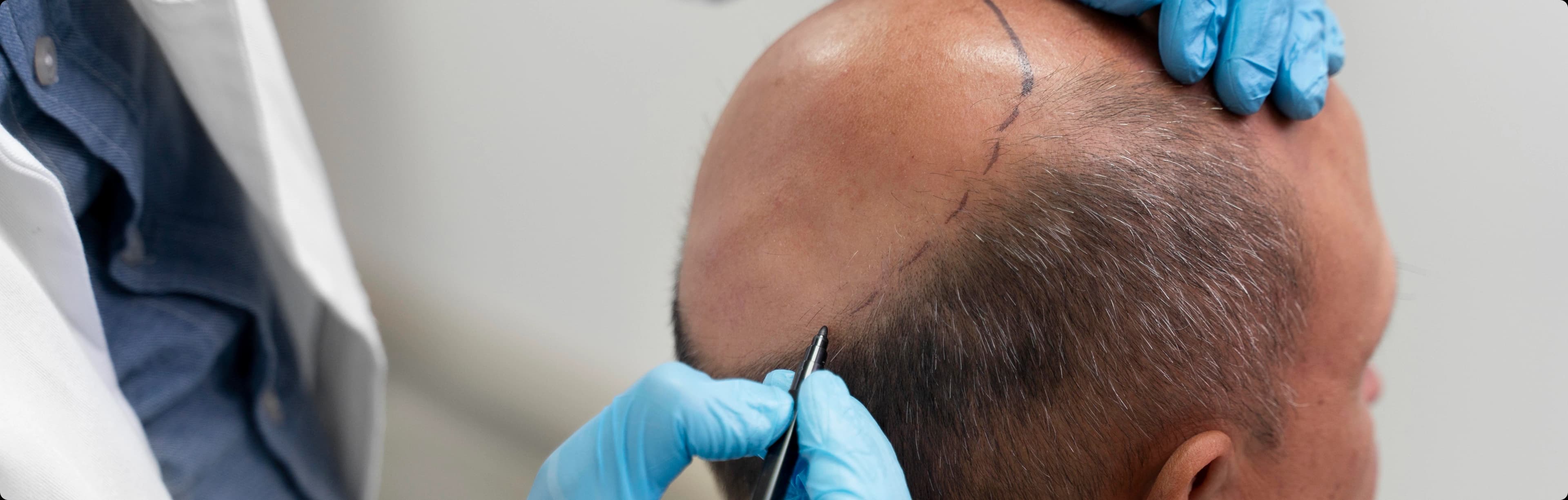 Facial hair restoration procedure