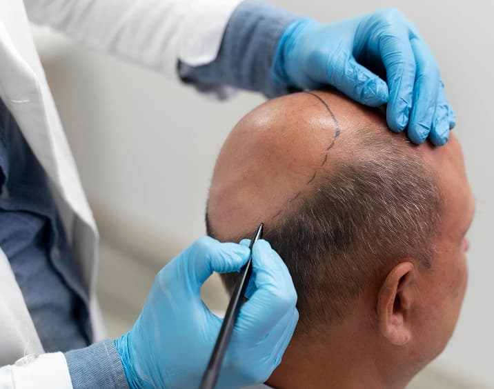 Facial hair restoration procedure