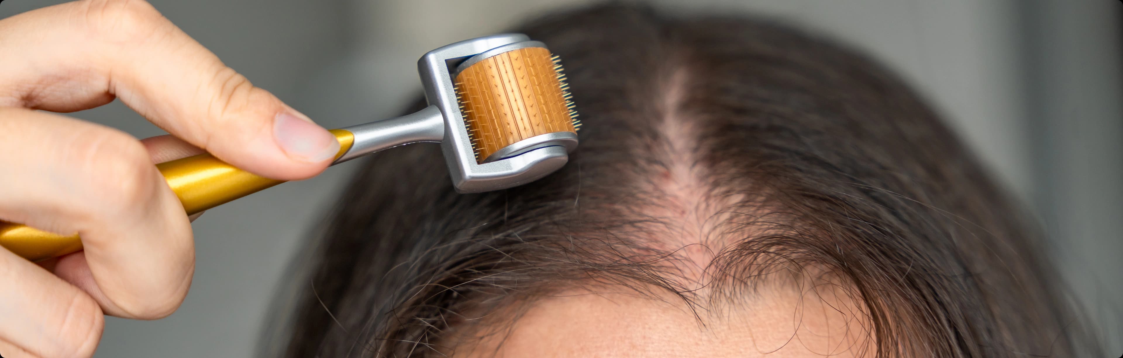 Microneedling for Hair Loss