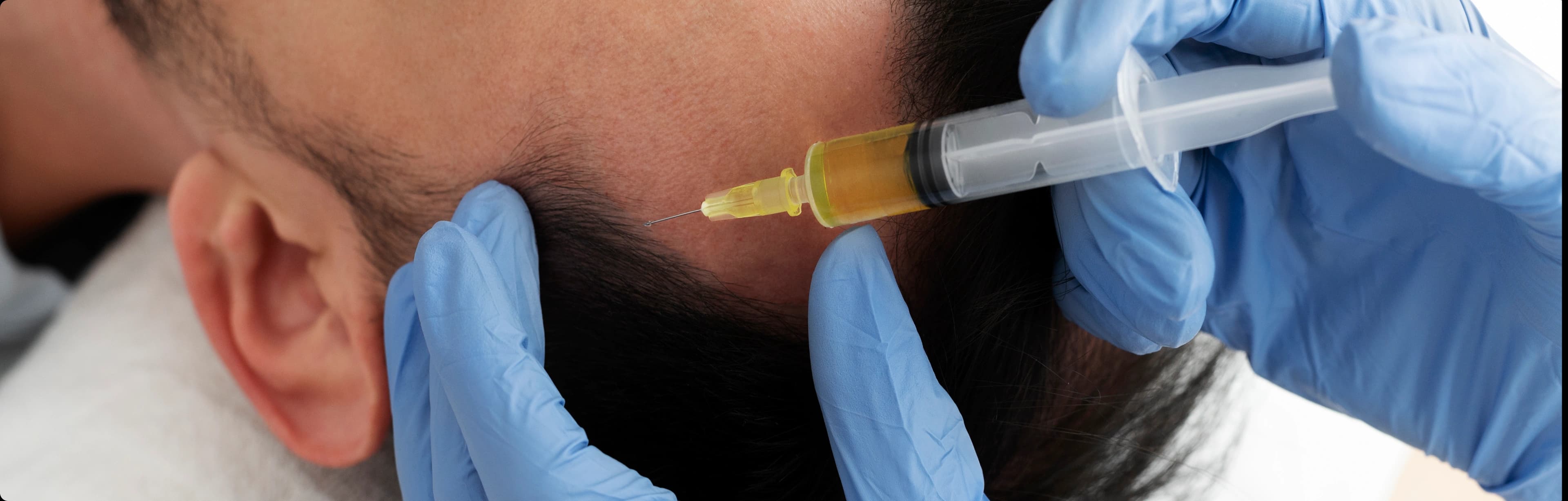 Microneedling for hair loss