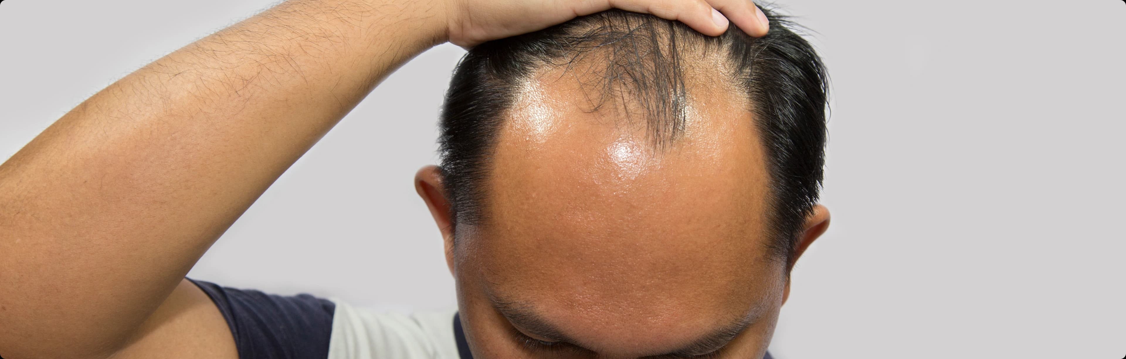 Custom Hair System Application