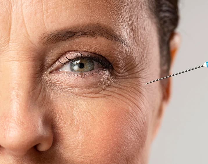 Mesotherapy treatment