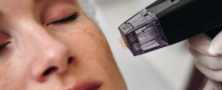 Microneedling Treatment