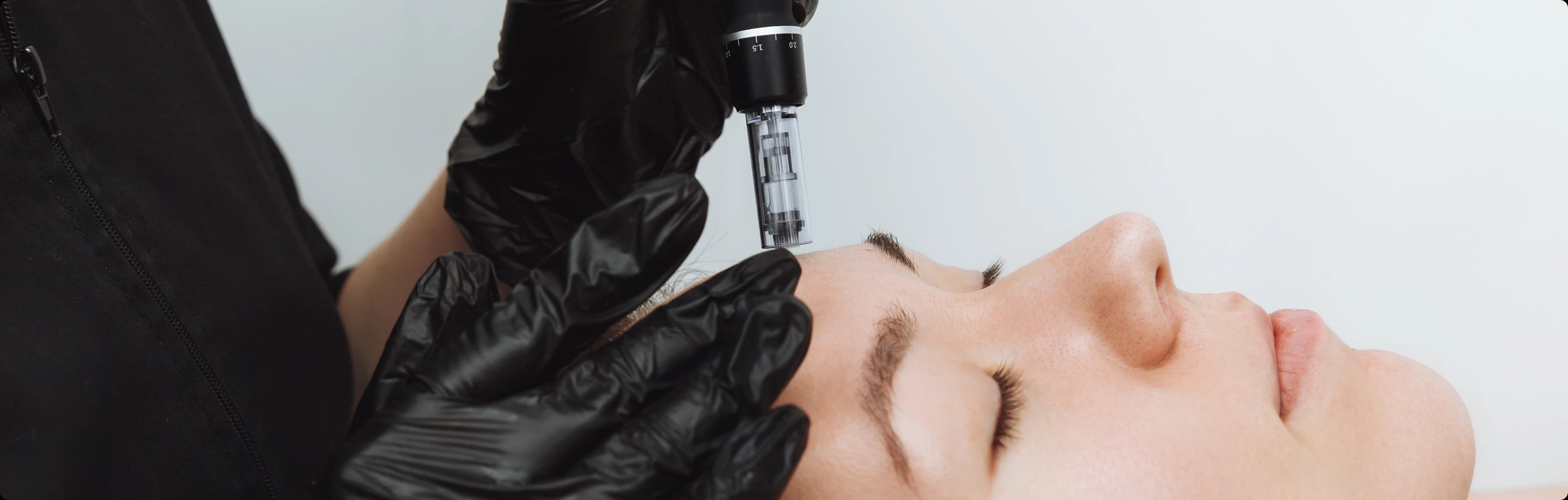 Microneedling treatment