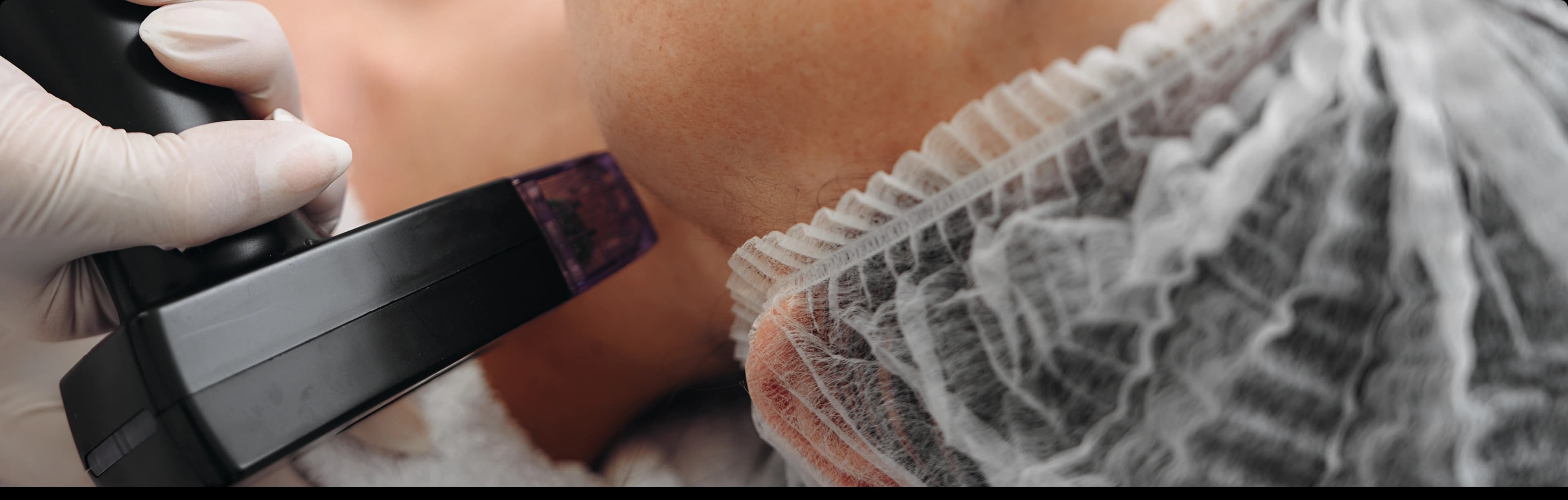 Microneedling facial