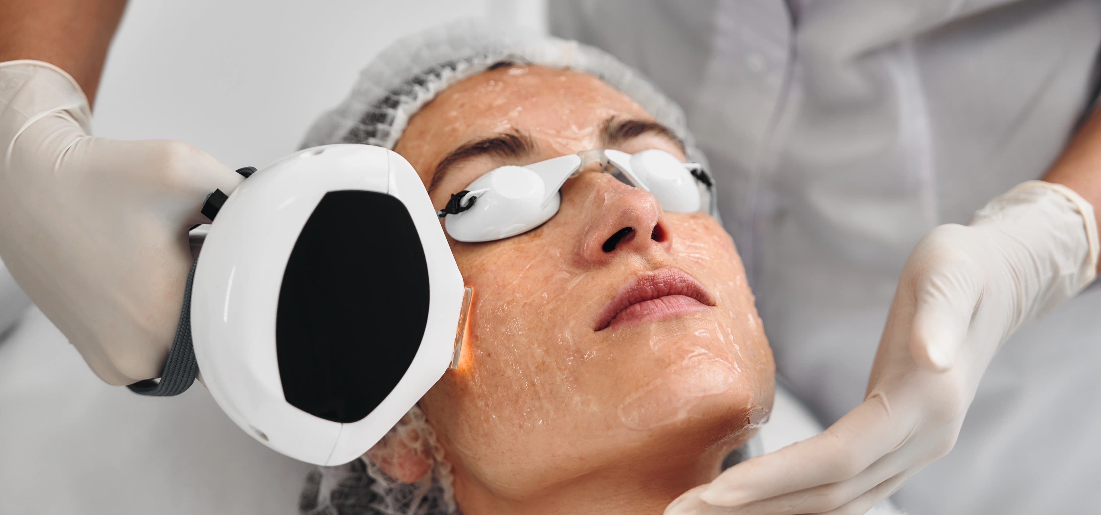 Photo Facial treatment