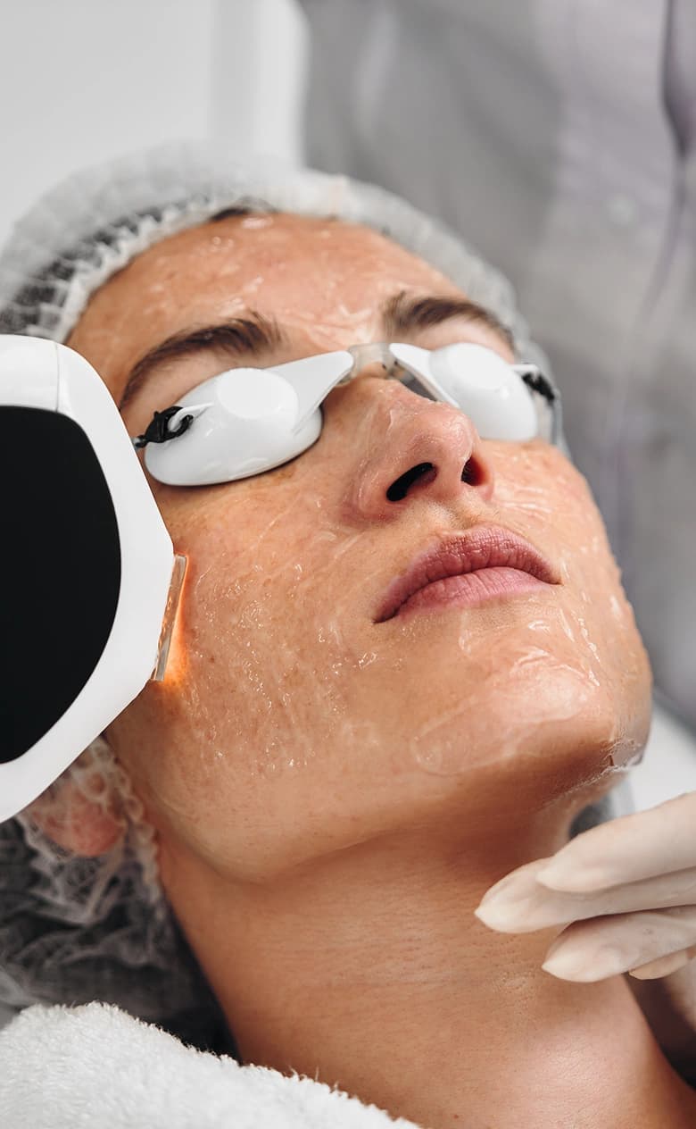 Photo Facial treatment