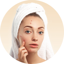 Adult acne (hormones, PCOS)