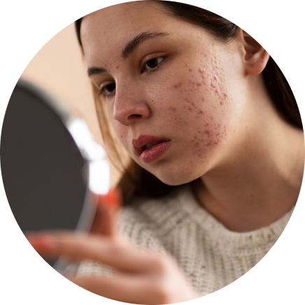 Pregnancy/postpartum acne